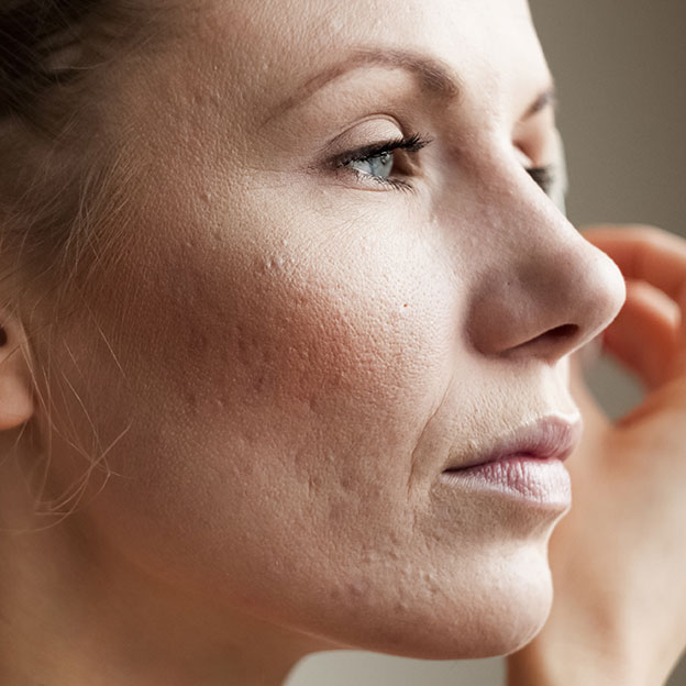 Problèmes de peau&nbsp;: quels produits de maquillage et de soin choisir?