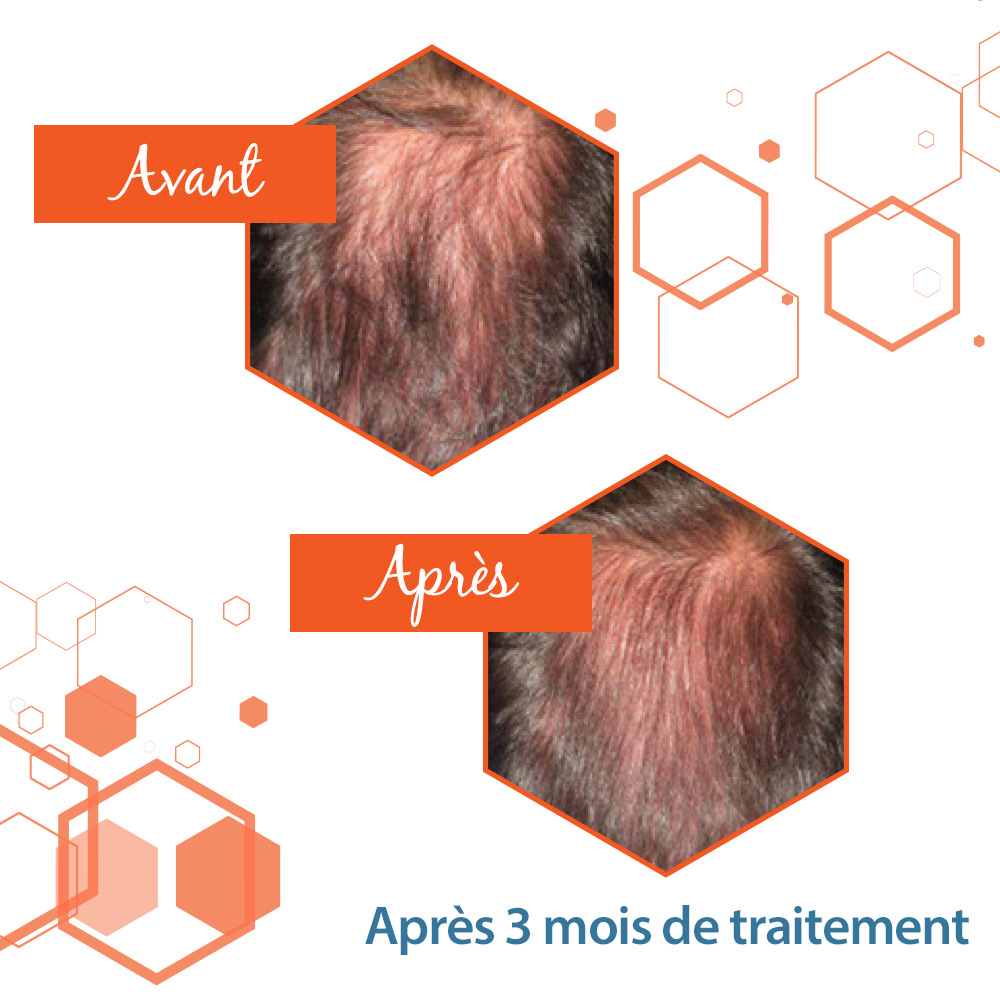 5 mythes sur la perte de cheveux chronique | Brunet