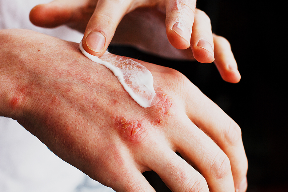Applying cream to a hand with eczema.