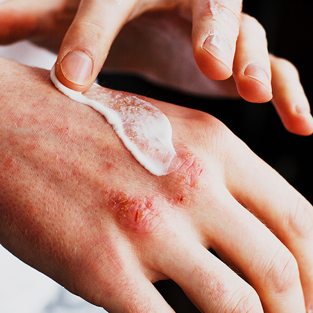 9 tips to prevent and treat eczema