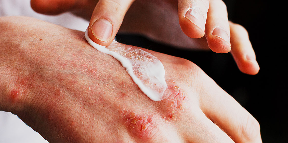 Applying cream to a hand with eczema.