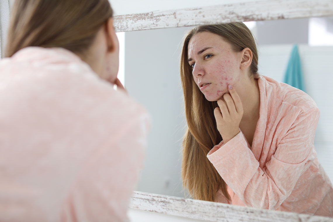 Femme avec longs cheveux châtains vêtue d’un peignoir rose qui regarde son visage avec de l’acné dans le miroir