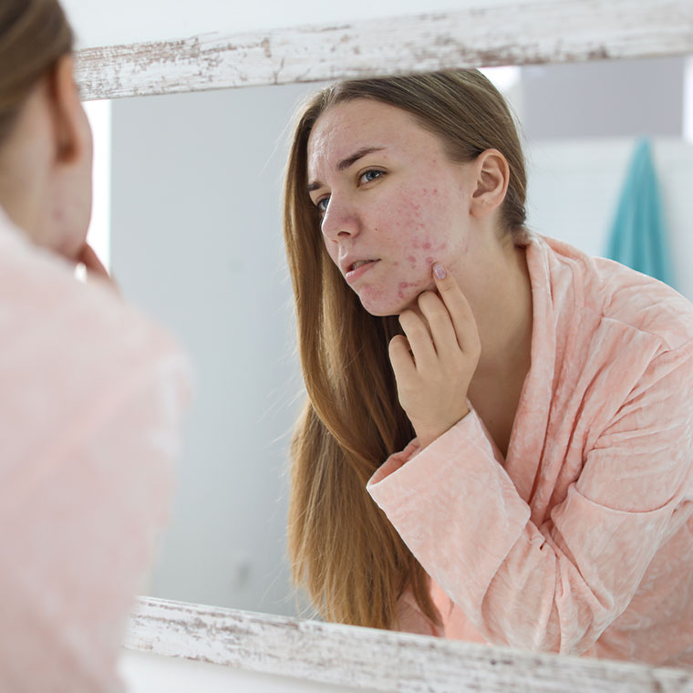 L’acné et les soins de la peau