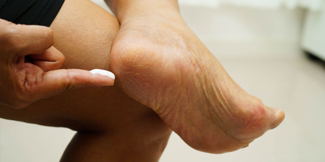 Astuces pour soulager durablement les champignons de peau (ou mycoses cutanées)