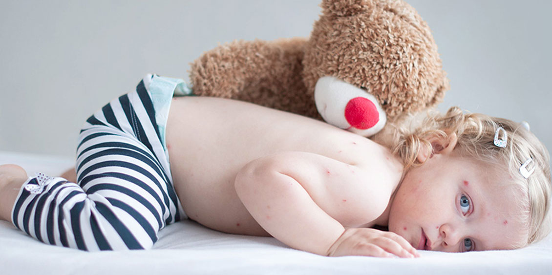 A little girl with chickenpox is comforted by her teddy bear.