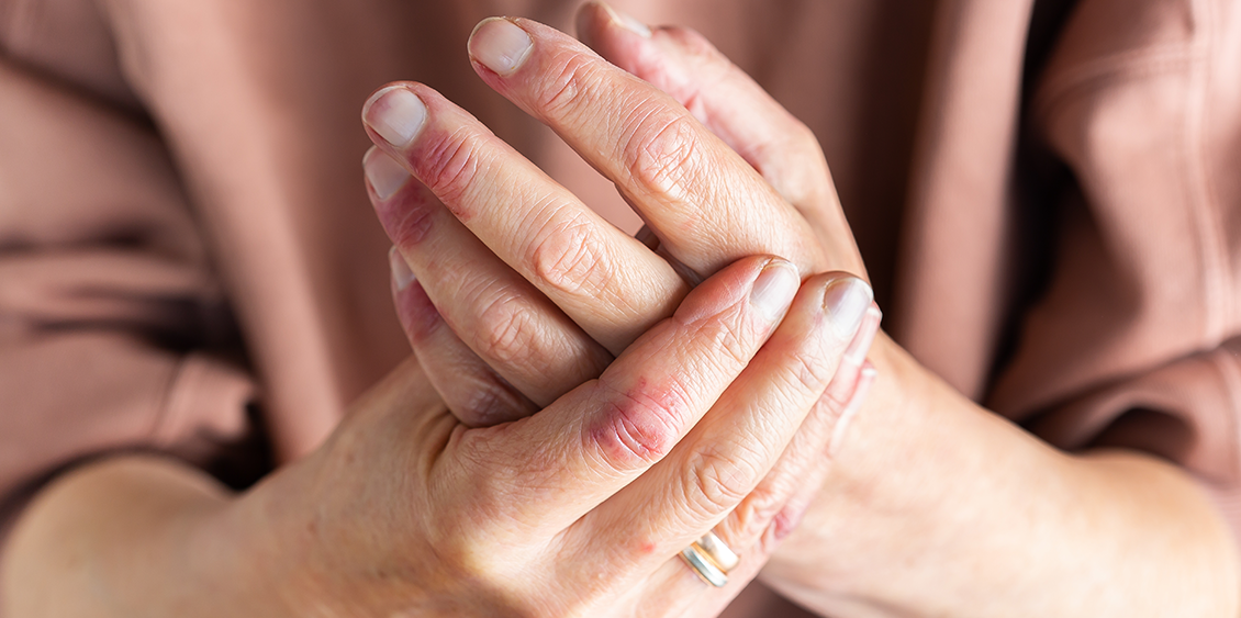 Taking care of eczema-prone skin