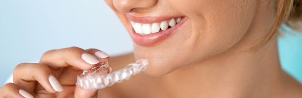Teeth bleaching at home supervised by a dentist