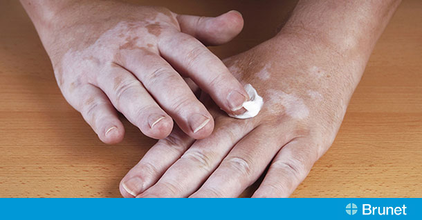 Le Vitiligo Quand La Peau Perd Son Pigment Brunet