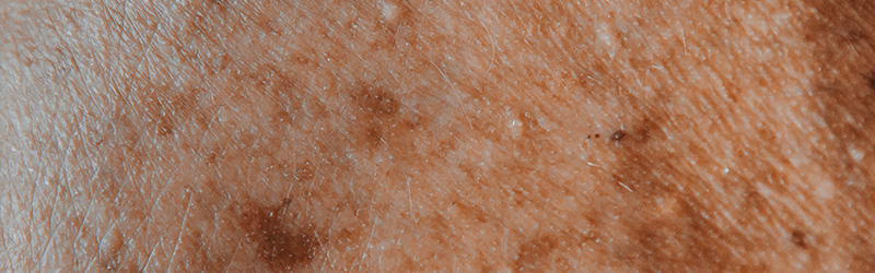 Effects on the skin