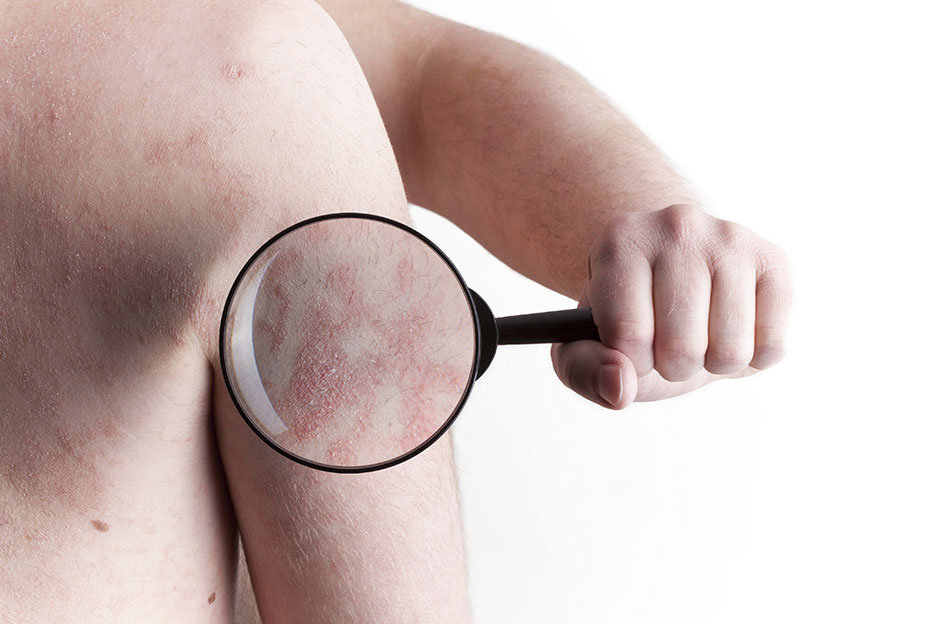 Le psoriasis | Brunet