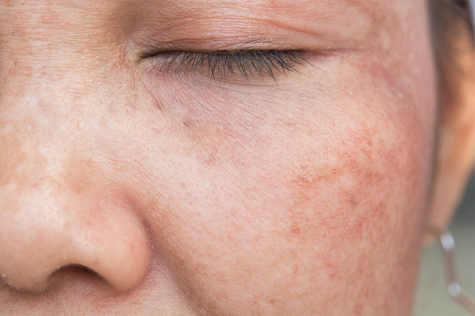 How to reduce dark spots?