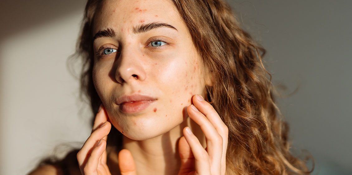 Une femme observe l'acné sur son visage dans le miroir
