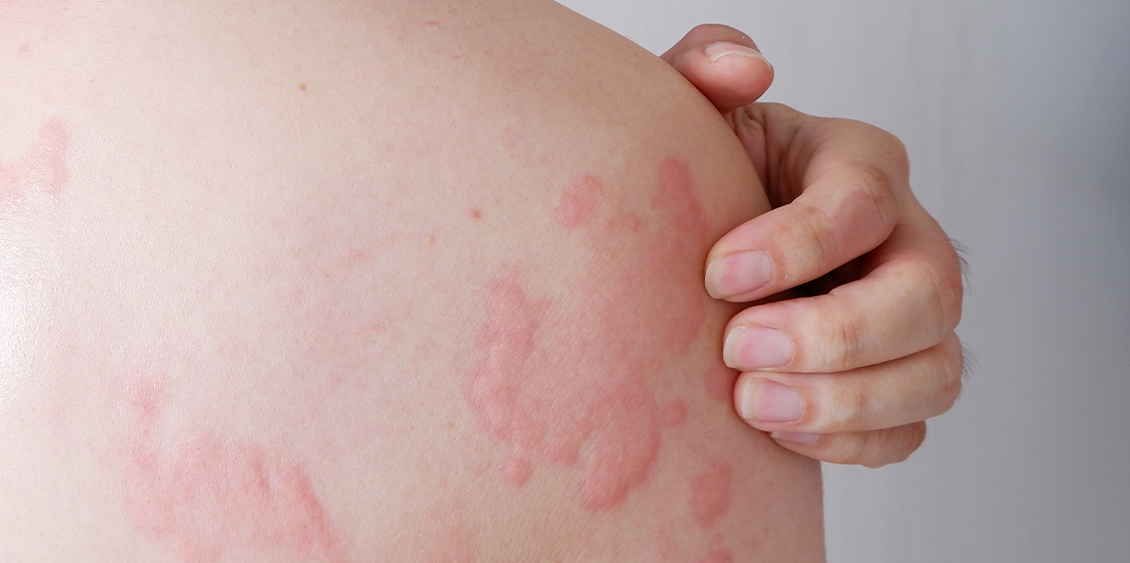 How to treat hives and prevent them from coming back