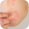 Psoriasis