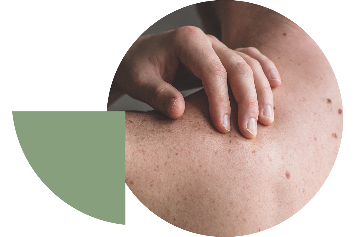 Soins de la peau en traitement oncologique