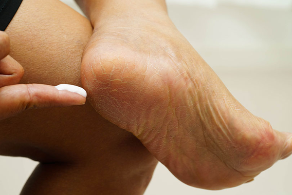 Tips for long-term relief from skin fungus