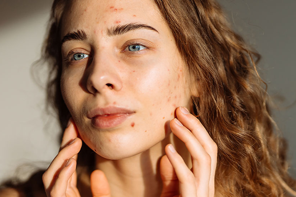 Comment reconna&icirc;tre mon type d'acn&eacute;?