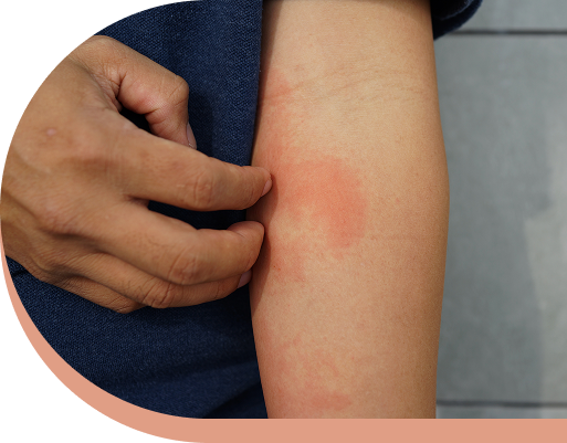 Pr&eacute;venir et apaiser les allergies cutan&eacute;es