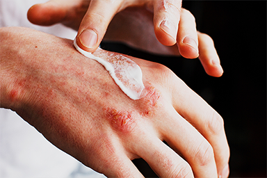 10 tips to prevent and treat eczema
