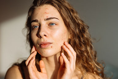 How to treat acne?