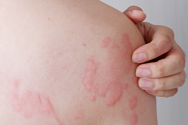 How to treat hives and prevent them from coming back